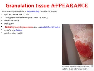 Granulation tissue AppeArAnce
During the migratory phase of wound healing, granulation tissue is:
 light red or dark pink in color,
  being perfused with new capillary loops or "buds"; 
 soft to the touch;
 moist; and
 bumpy (granular) in appearance, due to punctate hemorrhages
 pulseful on palpation 
 painless when healthy.
 