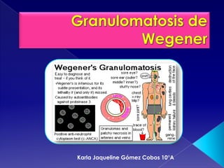 Granulomatosis de Wegener Karla Jaqueline Gómez Cobos 10°A  