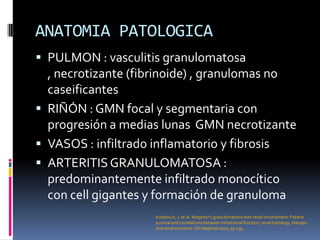ANATOMIA PATOLOGICA
 PULMON : vasculitis granulomatosa
  , necrotizante (fibrinoide) , granulomas no
  caseificantes
 RIÑÓN : GMN focal y segmentaria con
  progresión a medias lunas GMN necrotizante
 VASOS : infiltrado inflamatorio y fibrosis
 ARTERITIS GRANULOMATOSA :
  predominantemente infiltrado monocítico
  con cell gigantes y formación de granuloma
                    Koderisch, J, et al. Wegener's granulomatosis with renal involvement: Patient
                    survival and correlations between initial renal function, renal histology, therapy
                    and renal outcome. Clin Nephrol 2007; 35:139.
 