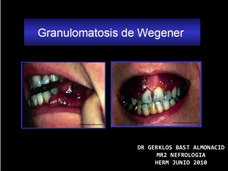 Granulomatosis de wegener