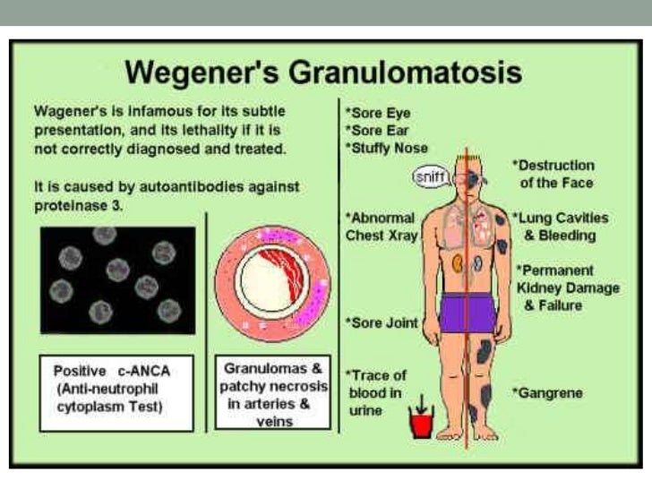 Granulomatosis de wegener