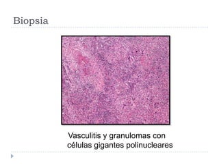 Biopsia
Vasculitis y granulomas con
células gigantes polinucleares
 