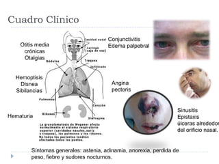 Cuadro Clínico
Sinusitis
Epistaxis
úlceras alrededor
del orificio nasal.
Otitis media
crónicas
Otalgias
Síntomas generales: astenia, adinamia, anorexia, perdida de
peso, fiebre y sudores nocturnos.
Hematuria
Angina
pectoris
Hemoptisis
Disnea
Sibilancias
Conjunctivitis
Edema palpebral
 