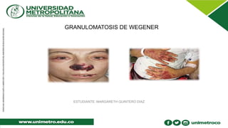 GRANULOMATOSIS DE WEGENER
ESTUDIANTE: MARGARETH QUINTERO DIAZ
 