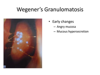 Wegener’s Granulomatosis
• Early changes
– Angry mucosa
– Mucous hypersecretion
 