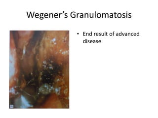Wegener’s Granulomatosis
• End result of advanced
disease
 