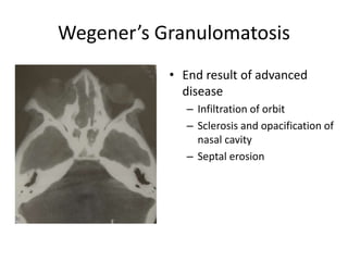 Wegener’s Granulomatosis
• End result of advanced
disease
– Infiltration of orbit
– Sclerosis and opacification of
nasal cavity
– Septal erosion
 