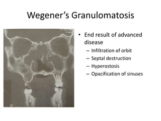 Wegener’s Granulomatosis
• End result of advanced
disease
– Infiltration of orbit
– Septal destruction
– Hyperostosis
– Opacification of sinuses
 