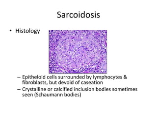 Sarcoidosis
• Histology
– Epitheloid cells surrounded by lymphocytes &
fibroblasts, but devoid of caseation
– Crystalline or calcified inclusion bodies sometimes
seen (Schaumann bodies)
 