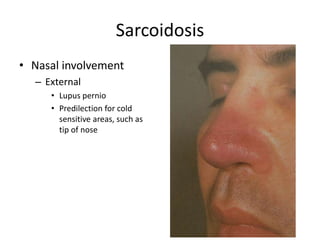 Sarcoidosis
• Nasal involvement
– External
• Lupus pernio
• Predilection for cold
sensitive areas, such as
tip of nose
 