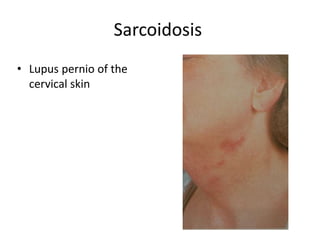 Sarcoidosis
• Lupus pernio of the
cervical skin
 