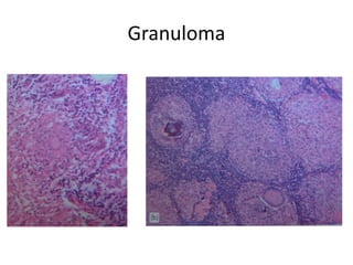 Granuloma
 