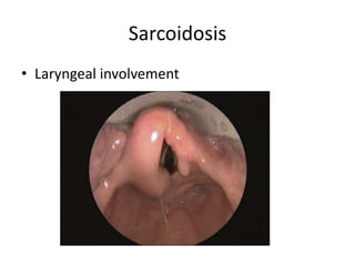 Sarcoidosis
• Laryngeal involvement
 