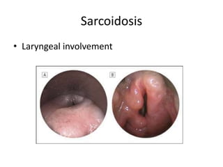 Sarcoidosis
• Laryngeal involvement
 