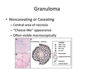 Granuloma
• Noncaseating or Caseating
– Central area of necrosis
– “Cheese-like” appearance
– Often visible macroscopically
 