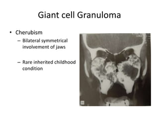 Giant cell Granuloma
• Cherubism
– Bilateral symmetrical
involvement of jaws
– Rare inherited childhood
condition
 