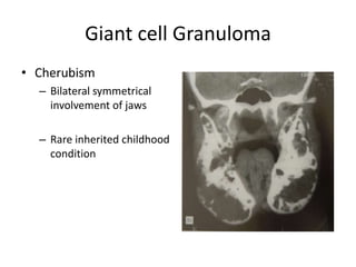 Giant cell Granuloma
• Cherubism
– Bilateral symmetrical
involvement of jaws
– Rare inherited childhood
condition
 