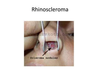 Rhinoscleroma
 