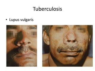 Tuberculosis
• Lupus vulgaris
 