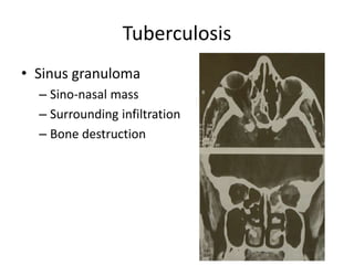 Tuberculosis
• Sinus granuloma
– Sino-nasal mass
– Surrounding infiltration
– Bone destruction
 