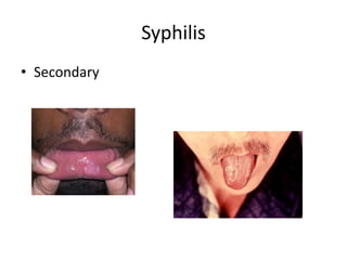 Syphilis
• Secondary
 