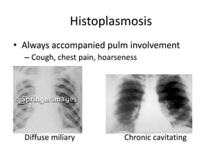 Histoplasmosis
• Always accompanied pulm involvement
– Cough, chest pain, hoarseness
Diffuse miliary Chronic cavitating
 