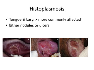 Histoplasmosis
• Tongue & Larynx more commonly affected
• Either nodules or ulcers
 