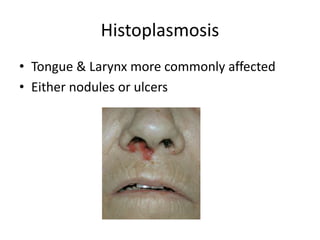 Histoplasmosis
• Tongue & Larynx more commonly affected
• Either nodules or ulcers
 