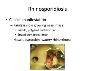 Rhinosporidiosis
• Clinical manifestation
– Painless slow growing nasal mass
• Friable, polypoid and vascular
• Strawberry appearance
– Nasal obstruction, watery rhinorrhoea
 