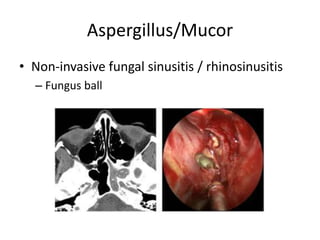 Aspergillus/Mucor
• Non-invasive fungal sinusitis / rhinosinusitis
– Fungus ball
 