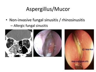 Aspergillus/Mucor
• Non-invasive fungal sinusitis / rhinosinusitis
– Allergic fungal sinusitis
 