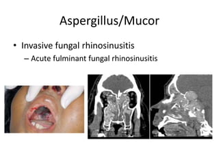Aspergillus/Mucor
• Invasive fungal rhinosinusitis
– Acute fulminant fungal rhinosinusitis
 