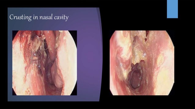 p anca blood test nose Granulomatous of disease p anca blood test nose Granulomatous of disease