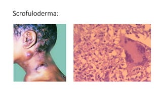 GRANULOMATOUS LESION OF SKIN2[299] - Read-Only (1).pptx
