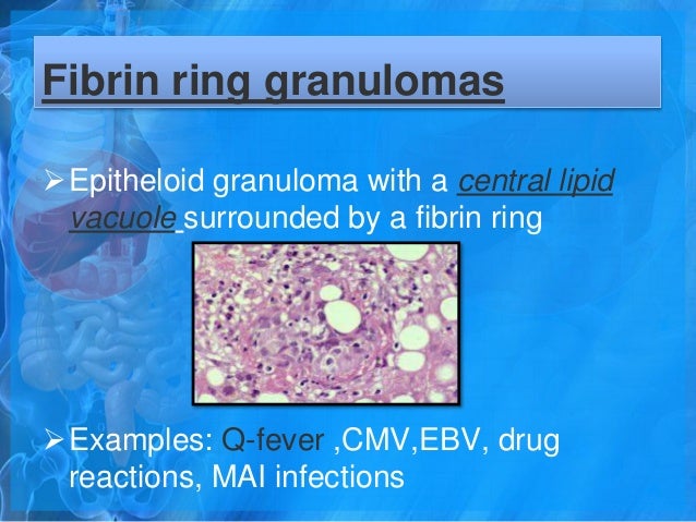 Fibrin Ring Granuloma Liver Fibrin Ring Granuloma Liver