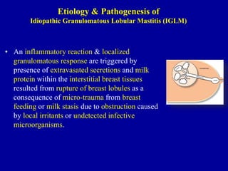 • An inflammatory reaction & localized
granulomatous response are triggered by
presence of extravasated secretions and milk
protein within the interstitial breast tissues
resulted from rupture of breast lobules as a
consequence of micro-trauma from breast
feeding or milk stasis due to obstruction caused
by local irritants or undetected infective
microorganisms.
Etiology & Pathogenesis of
Idiopathic Granulomatous Lobular Mastitis (IGLM)
 