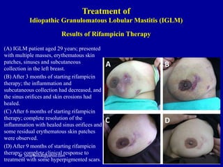 (A) IGLM patient aged 29 years; presented
with multiple masses, erythematous skin
patches, sinuses and subcutaneous
collection in the left breast.
(B) After 3 months of starting rifampicin
therapy; the inflammation and
subcutaneous collection had decreased, and
the sinus orifices and skin erosions had
healed.
(C) After 6 months of starting rifampicin
therapy; complete resolution of the
inflammation with healed sinus orifices and
some residual erythematous skin patches
were observed.
(D) After 9 months of starting rifampicin
therapy; complete clinical response to
treatment with some hyperpigmented scars.
dr_omarfarouk@yahoo.com
Results of Rifampicin Therapy
Treatment of
Idiopathic Granulomatous Lobular Mastitis (IGLM)
 