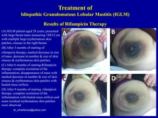 (A) IGLM patient aged 28 years; presented
with large breast mass measuring 14X12 cm
with multiple large erythematous skin
patches, sinuses in the right breast.
(B) After 3 months of starting of
rifampicin therapy; marked decrease in size
of mass, decrease in number & size of skin
sinuses & erythematous skin patches.
(C) After 6 months of starting Rifampicin
therapy; complete resolution of the
inflammation, disappearance of mass with
marked decrease in number & size of skin
sinuses & erythematous skin patches with
healed sinus orifices
(D) After 9 months of starting rifampicin
therapy; complete resolution of the
inflammation with healed sinus orifices and
some residual erythematous skin patches
were observed.
dr_omarfarouk@yahoo.com
Results of Rifampicin Therapy
Treatment of
Idiopathic Granulomatous Lobular Mastitis (IGLM)
 