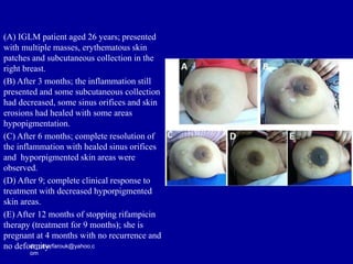 dr_omarfarouk@yahoo.c
om
(A) IGLM patient aged 26 years; presented
with multiple masses, erythematous skin
patches and subcutaneous collection in the
right breast.
(B) After 3 months; the inflammation still
presented and some subcutaneous collection
had decreased, some sinus orifices and skin
erosions had healed with some areas
hypopigmentation.
(C) After 6 months; complete resolution of
the inflammation with healed sinus orifices
and hyporpigmented skin areas were
observed.
(D) After 9; complete clinical response to
treatment with decreased hyporpigmented
skin areas.
(E) After 12 months of stopping rifampicin
therapy (treatment for 9 months); she is
pregnant at 4 months with no recurrence and
no deformity.
 