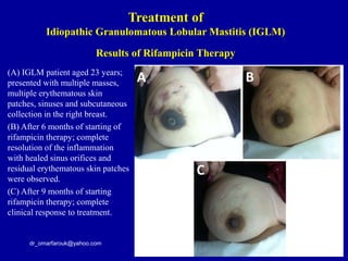 (A) IGLM patient aged 23 years;
presented with multiple masses,
multiple erythematous skin
patches, sinuses and subcutaneous
collection in the right breast.
(B) After 6 months of starting of
rifampicin therapy; complete
resolution of the inflammation
with healed sinus orifices and
residual erythematous skin patches
were observed.
(C) After 9 months of starting
rifampicin therapy; complete
clinical response to treatment.
dr_omarfarouk@yahoo.com
Results of Rifampicin Therapy
Treatment of
Idiopathic Granulomatous Lobular Mastitis (IGLM)
 