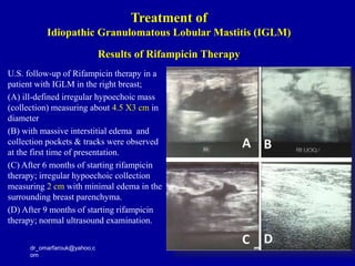 U.S. follow-up of Rifampicin therapy in a
patient with IGLM in the right breast;
(A) ill-defined irregular hypoechoic mass
(collection) measuring about 4.5 X3 cm in
diameter
(B) with massive interstitial edema and
collection pockets & tracks were observed
at the first time of presentation.
(C) After 6 months of starting rifampicin
therapy; irregular hypoechoic collection
measuring 2 cm with minimal edema in the
surrounding breast parenchyma.
(D) After 9 months of starting rifampicin
therapy; normal ultrasound examination.
dr_omarfarouk@yahoo.c
om
Results of Rifampicin Therapy
Treatment of
Idiopathic Granulomatous Lobular Mastitis (IGLM)
 