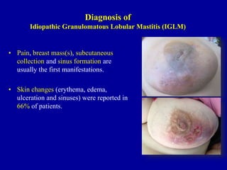 Diagnosis of
Idiopathic Granulomatous Lobular Mastitis (IGLM)
• Pain, breast mass(s), subcutaneous
collection and sinus formation are
usually the first manifestations.
• Skin changes (erythema, edema,
ulceration and sinuses) were reported in
66% of patients.
 