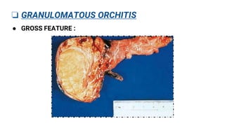 GRANULOMATOUS ORCHITIS .pptx | Medical Health