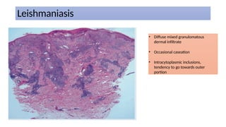 Caseation Hitopath Comprehensive Overview of Granulomatous Reaction Patterns in ...