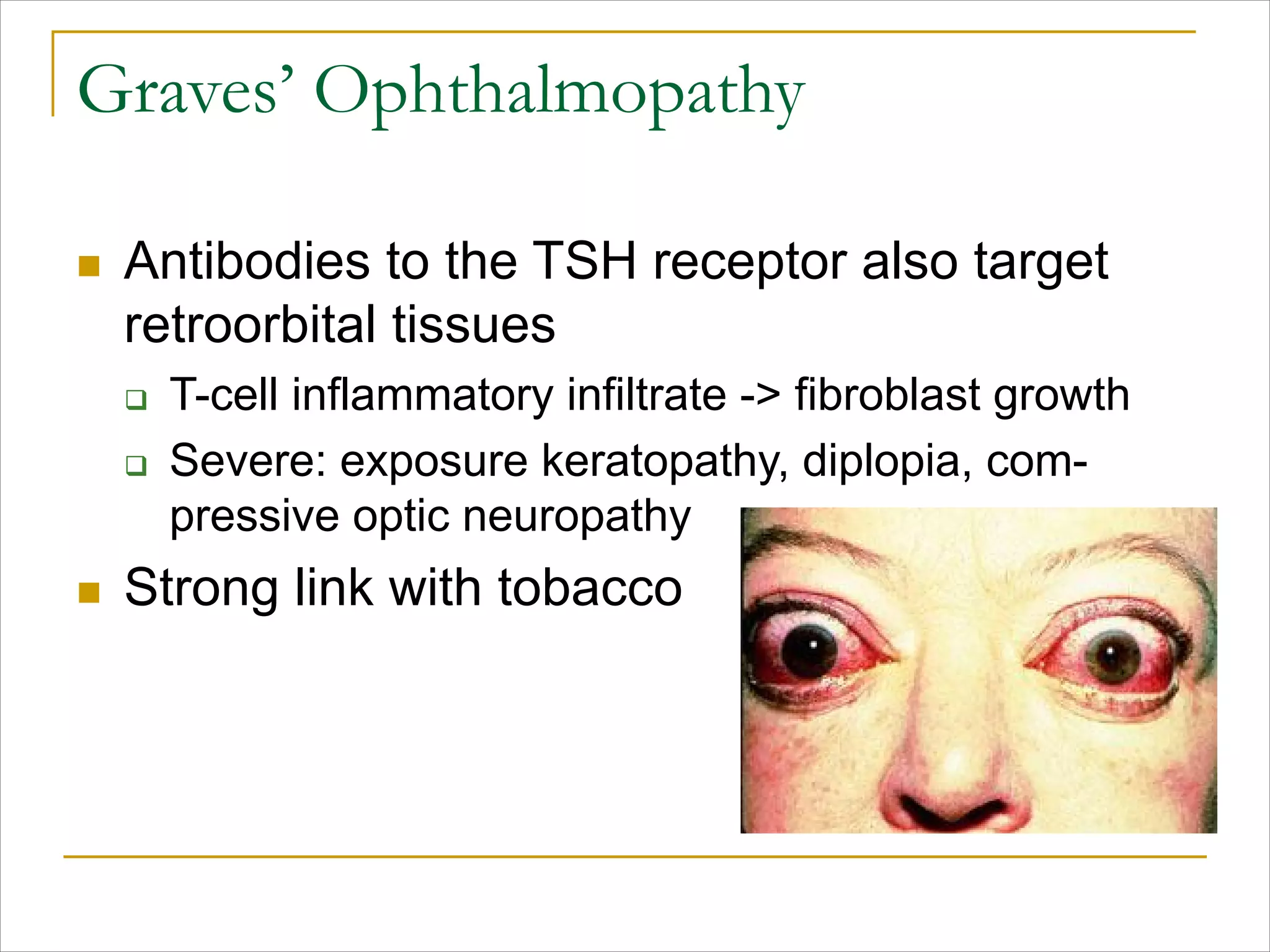 Graves’ Ophthalmopathy
n Antibodies to the TSH receptor also target
retroorbital tissues
q T-cell inflammatory infiltrate -> fibroblast growth
q Severe: exposure keratopathy, diplopia, com-
pressive optic neuropathy
n Strong link with tobacco
 