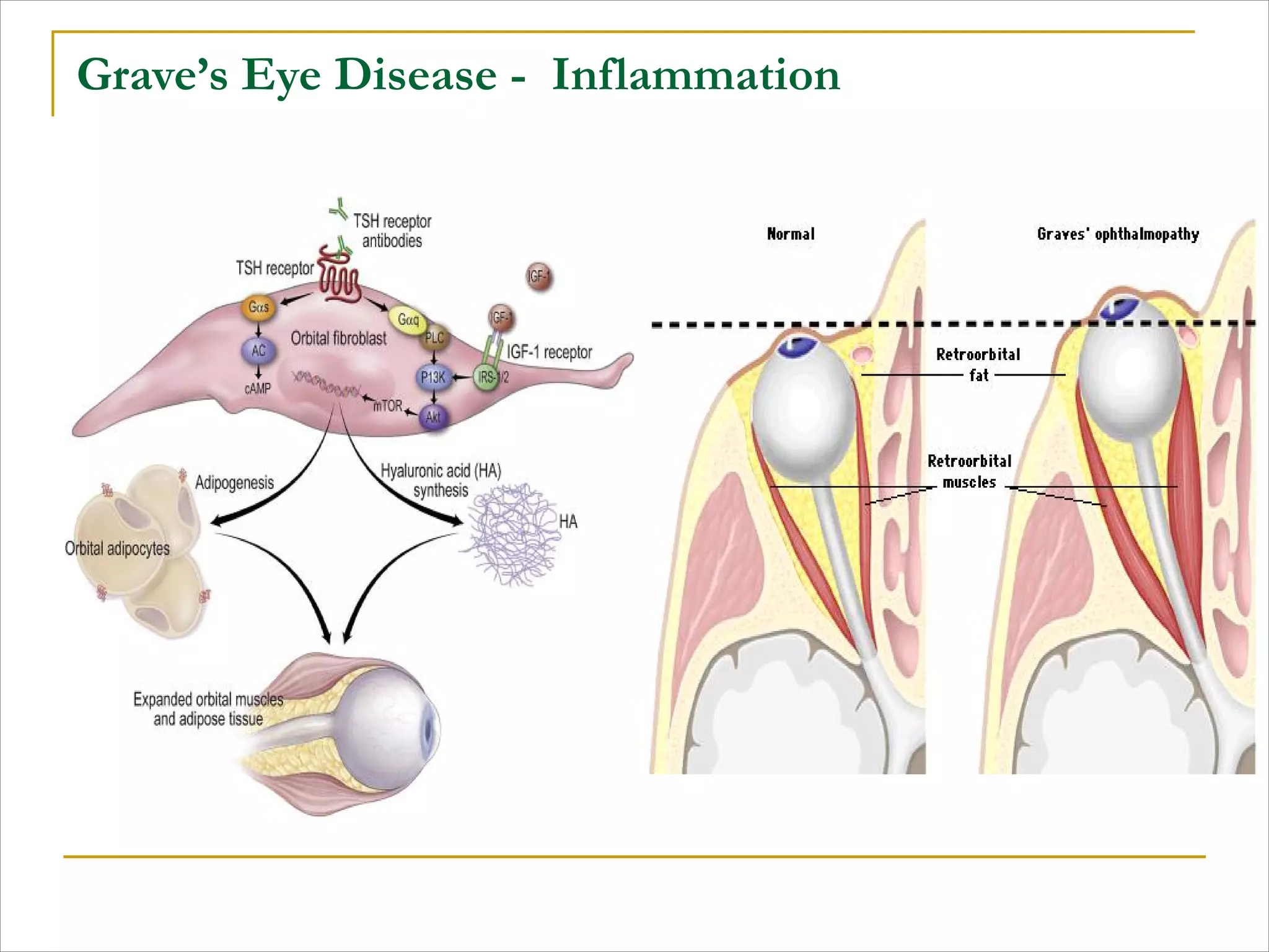 Grave’s Eye Disease - Inflammation
 