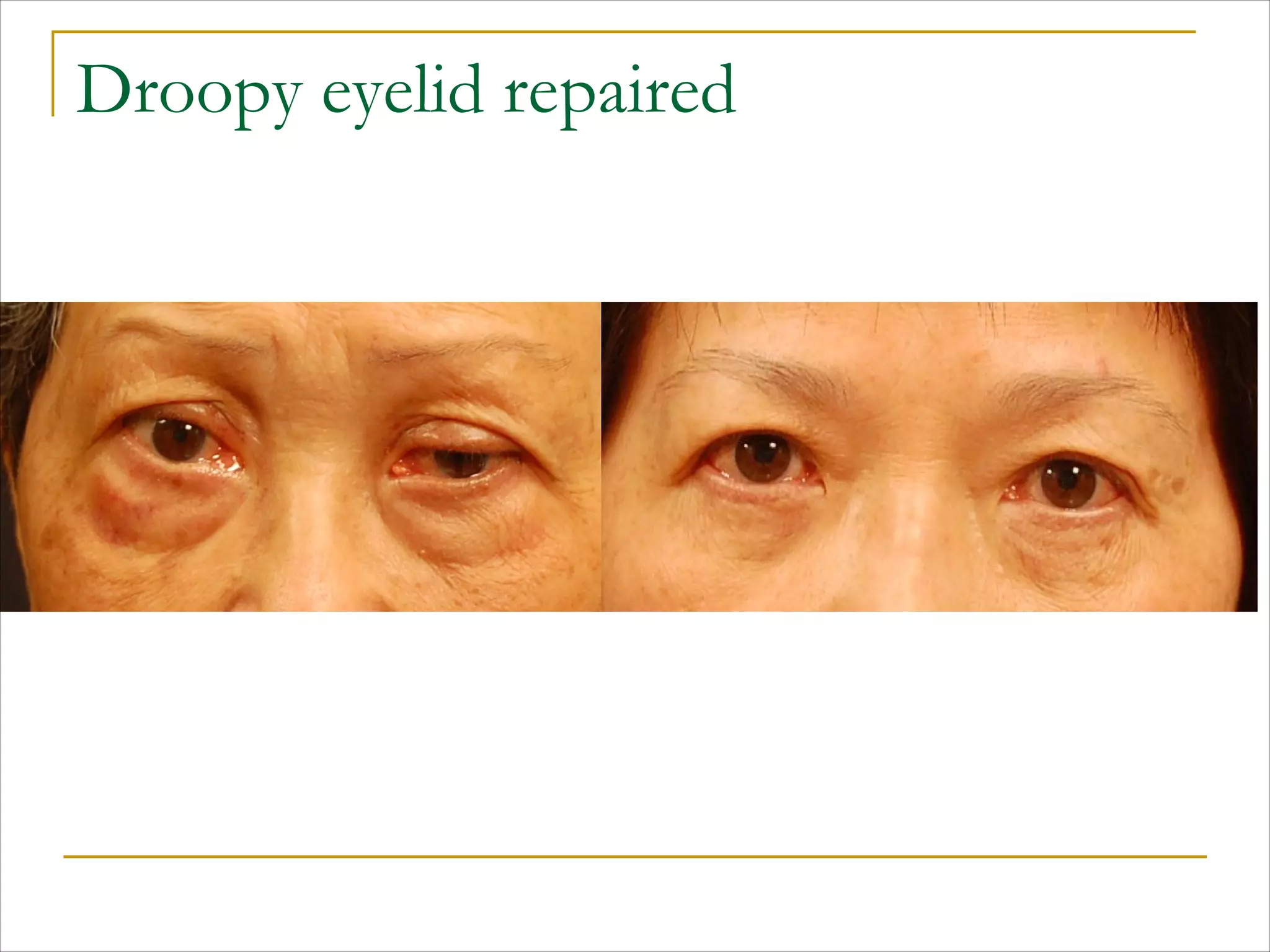 Droopy eyelid repaired
 