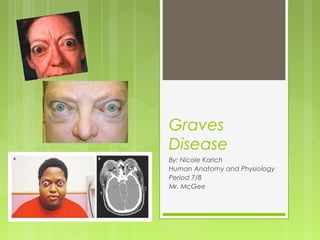Graves
Disease
By: Nicole Karich
Human Anatomy and Physiology
Period 7/8
Mr. McGee
 
