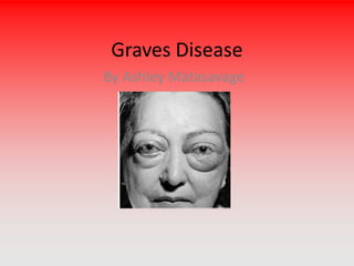 Graves Disease
By Ashley Matasavage
 