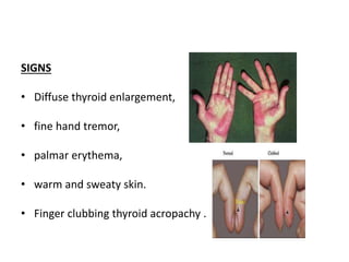 SIGNS
• Diffuse thyroid enlargement,
• fine hand tremor,
• palmar erythema,
• warm and sweaty skin.
• Finger clubbing thyroid acropachy .
 